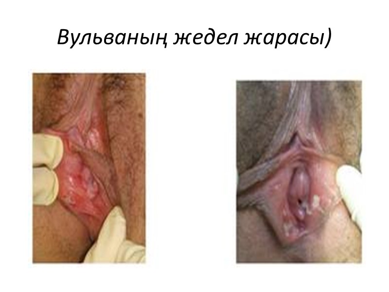 Вульваның жедел жарасы)